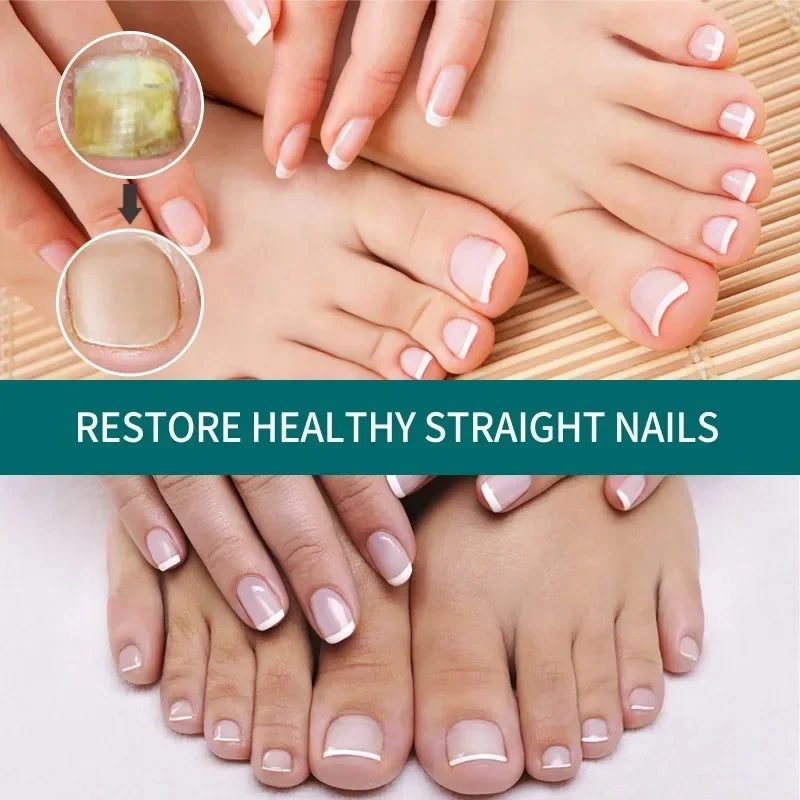 Antibacterial Liquid for Nail Fungus Nail Removal Cream Thickening Soft Nails Paronychia Treatment Beauty Health Feet Care Tools