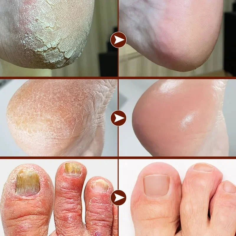 Herbal Anti Crack Foot Cream Heel Cracking Repair Products Exfoliation Dead Skin Removal Softening Moisturizing Hand Feet Care