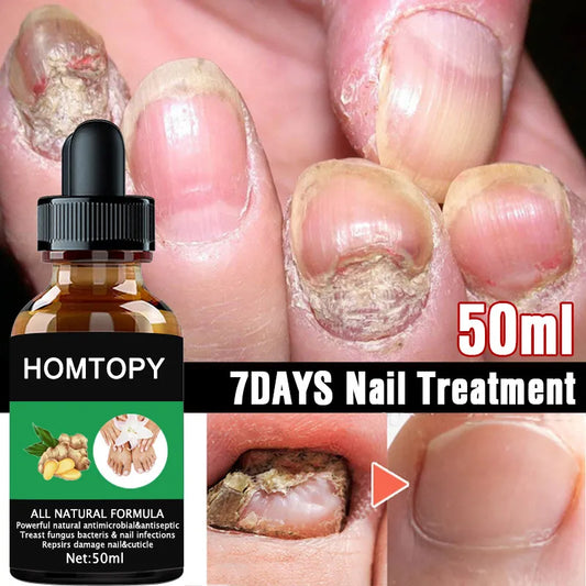 Efficient Nail Repair Solution Treating Cracked Discolored Nails Gray Foot Care Toe Nail Sterilization Gel Nourishing Essence